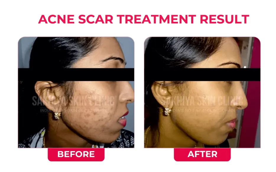 ACNE-SCAR-TREATMENT