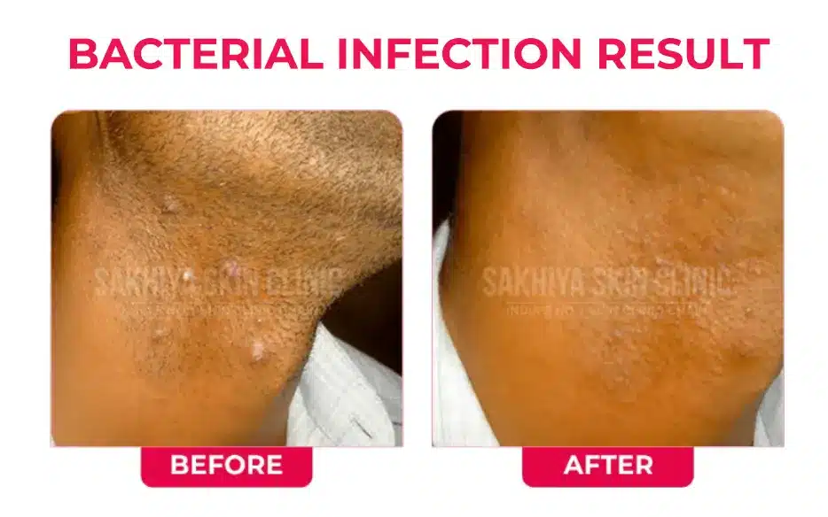 BACTERIAL-INFECTION-RESULT