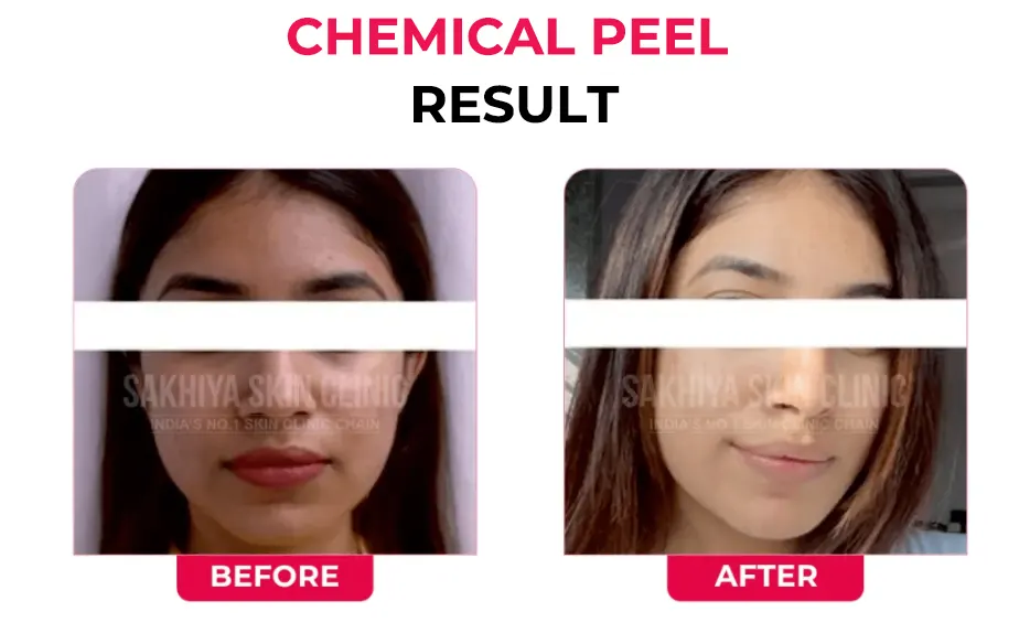 CHEMICAL-PEEL