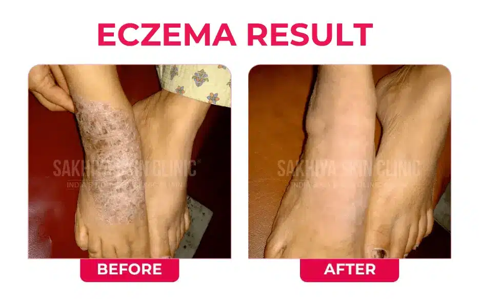 ECZEMA