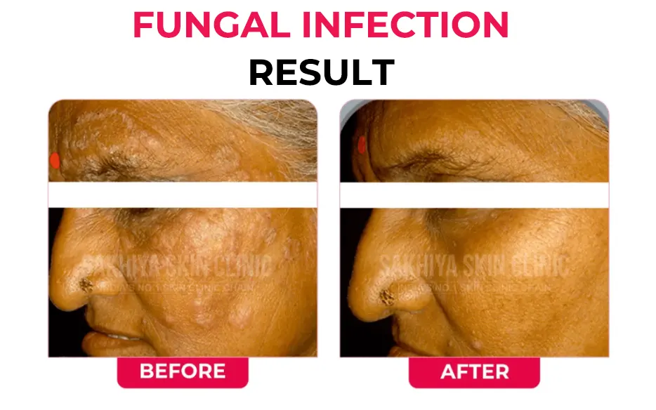 FUNGAL-INFECTION