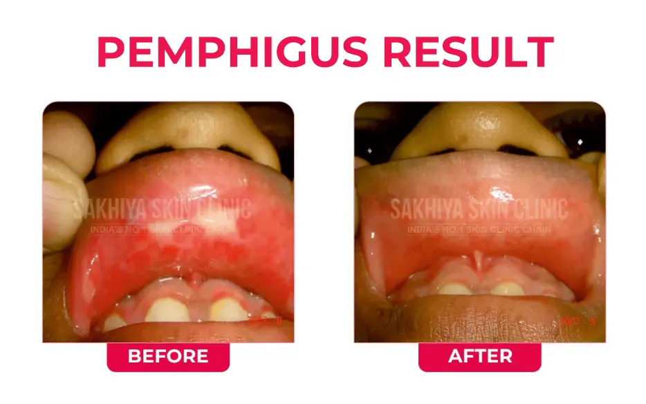 PEMPHIGUS