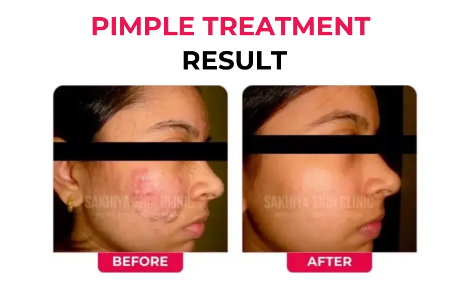 PIMPLE-TREATMENT-RESULT