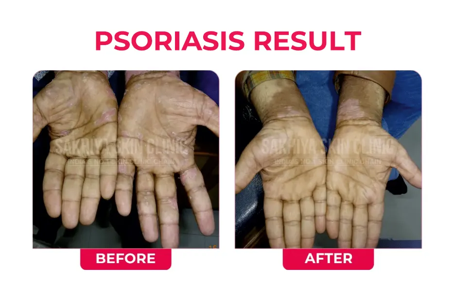 PSORIASIS-RESULT