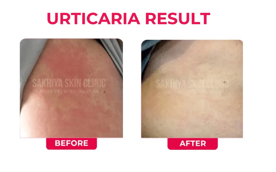 URTICARA