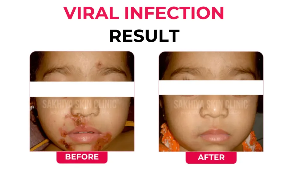 VIRAL-INFECTION