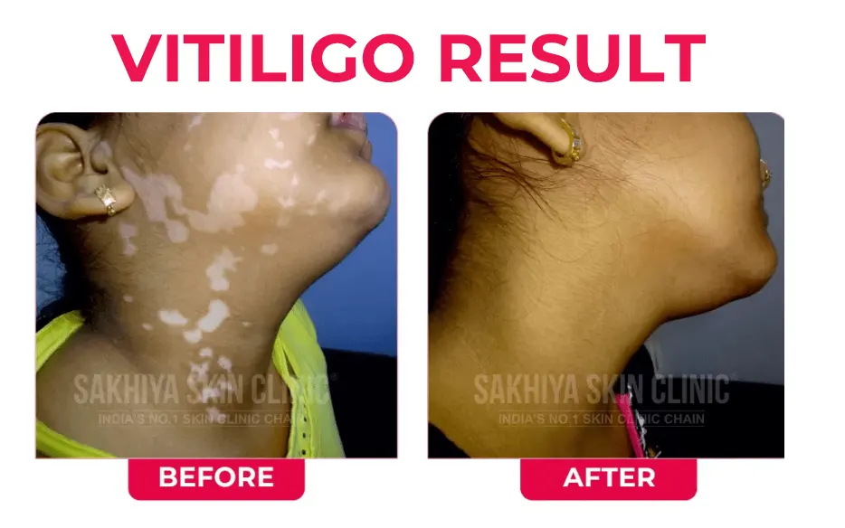 VITILIGO
